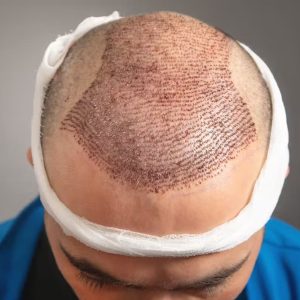 Scopri come funziona il trapianto di capelli in Albania. Tecniche moderne, risultati naturali e offerte da €2.200 presso Estetica e Sorriso.