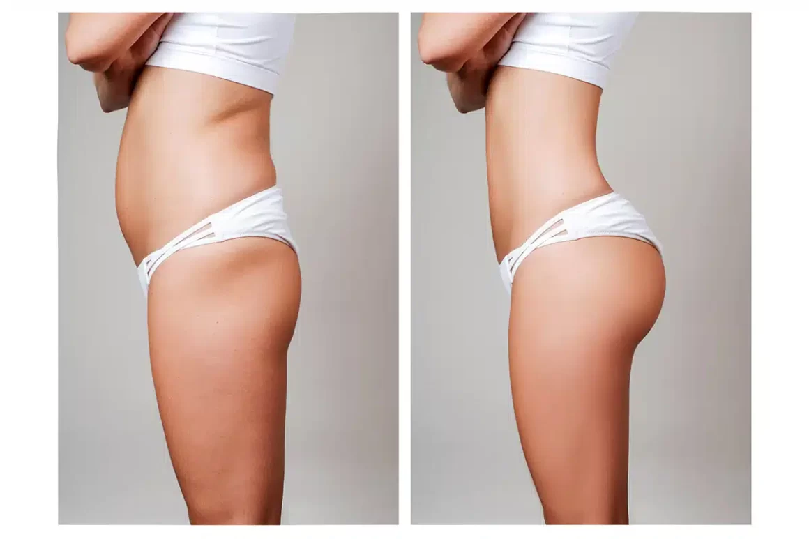 Vuoi sapere quanto costa Brazilian Butt Lift? Scopri perché l'Albania è la meta ideale per qualità, risparmio e risultati sicuri.