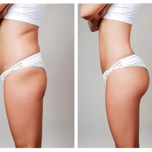 Vuoi sapere quanto costa Brazilian Butt Lift? Scopri perché l'Albania è la meta ideale per qualità, risparmio e risultati sicuri.