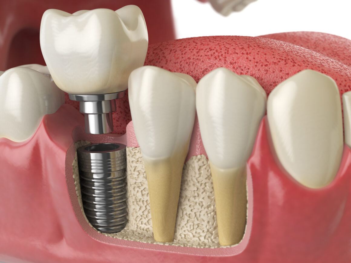 Impianti Dentali in Albania Estetica e Sorriso