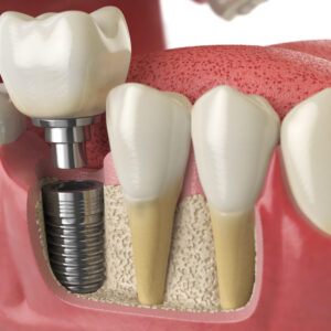 Impianti Dentali in Albania Estetica e Sorriso
