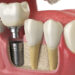 Impianti Dentali in Albania Estetica e Sorriso