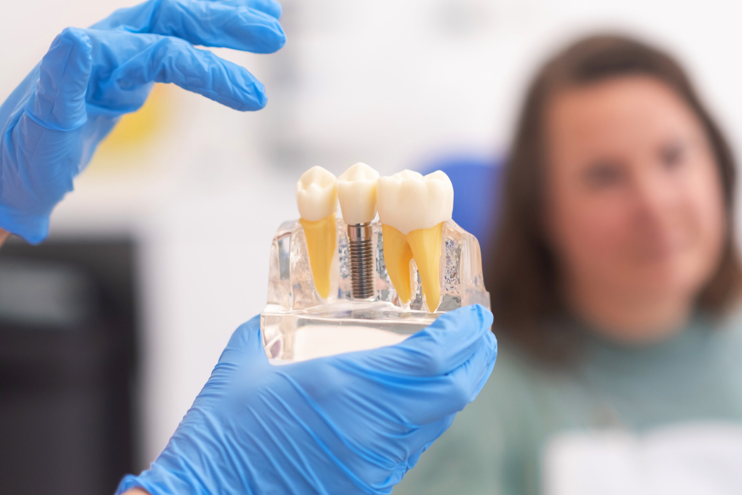Impianti Dentali in Albania Estetica e Sorriso