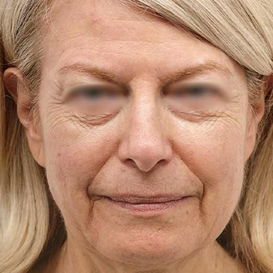 Estetica e Sorriso - Lifting del Viso prima