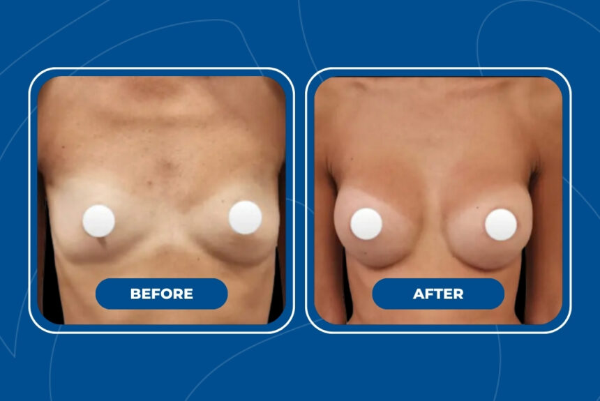 Mastoplastica Additiva - Estetica e Sorriso