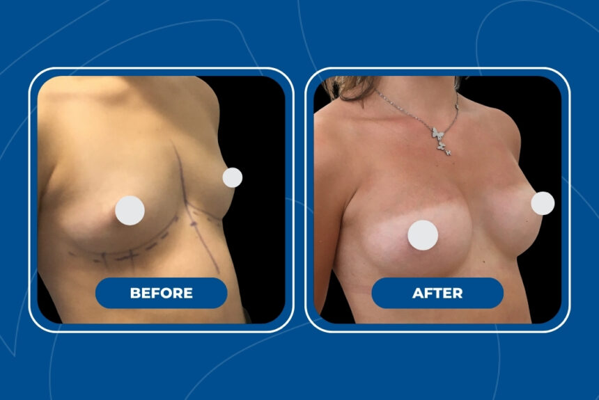 Mastoplastica Additiva - Estetica e Sorriso