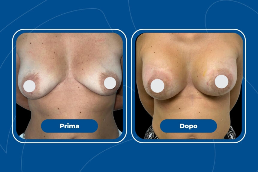 Mastoplastica Additiva - Estetica e Sorriso