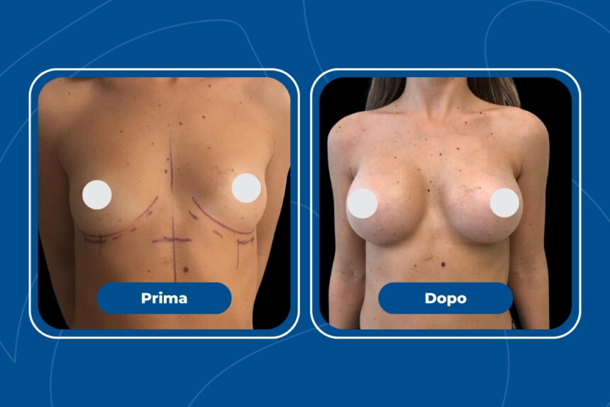 Mastoplastica Additiva - Estetica e Sorriso