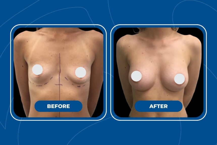 Mastoplastica Additiva - Estetica e Sorriso