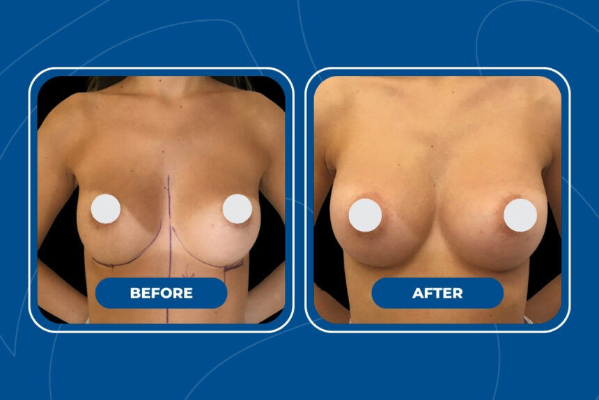 Mastoplastica Additiva - Estetica e Sorriso