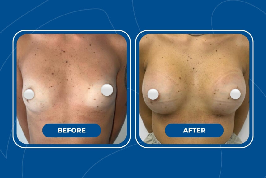 Mastoplastica Additiva - Estetica e Sorriso