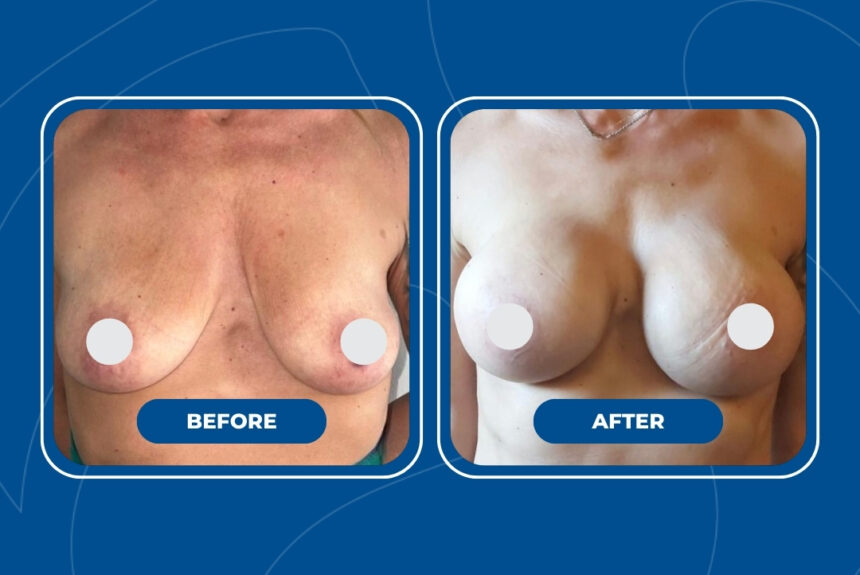 Mastoplastica Additiva - Estetica e Sorriso