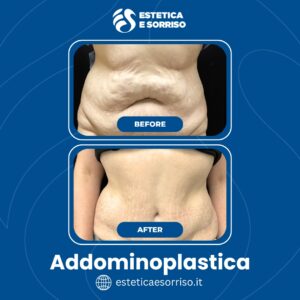 Addominoplastica in Albania – Estetica e Sorriso