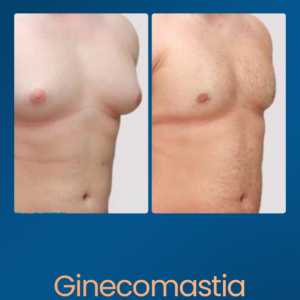 Ginecomastia - Estetica e Sorriso