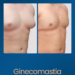 Ginecomastia - Estetica e Sorriso