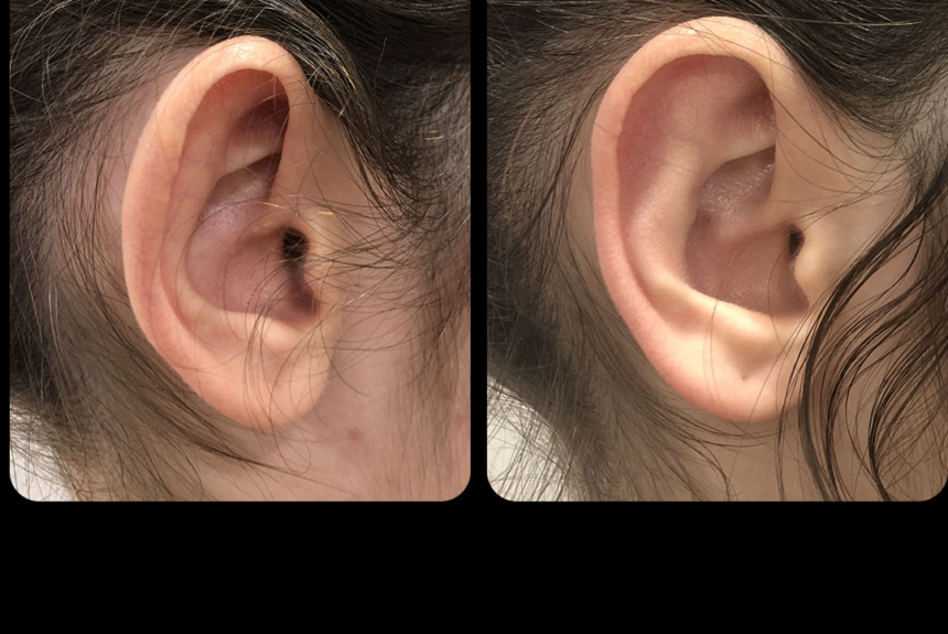 Otoplastica - Estetica e Sorriso