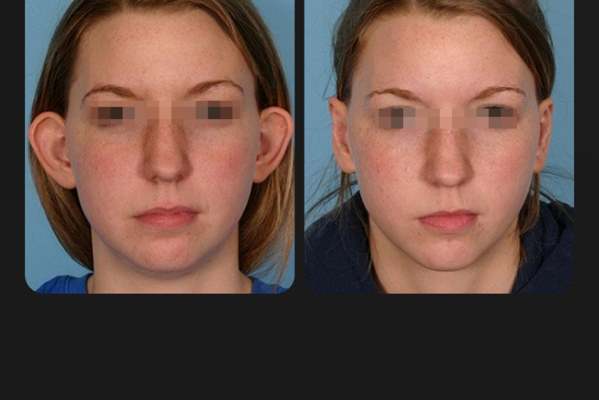 Otoplastica - Estetica e Sorriso