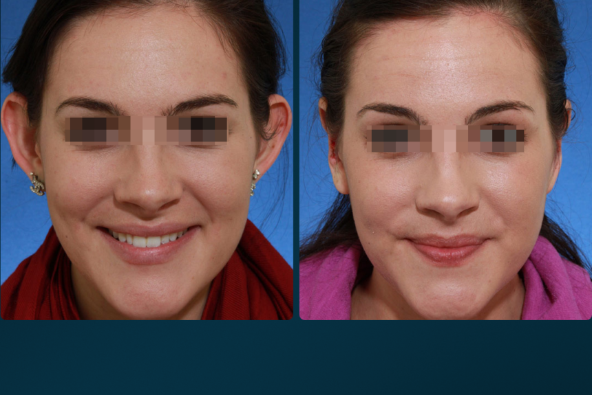 Otoplastica - Estetica e Sorriso