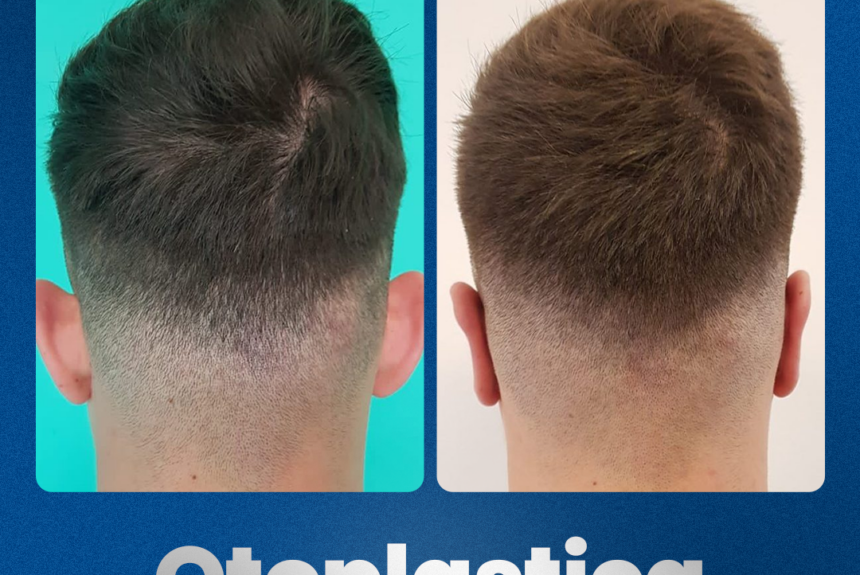 Otoplastica - Estetica e Sorriso