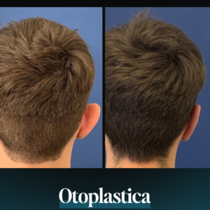 Otoplastica - Estetica e Sorriso - Estetica e Sorriso Otoplastica - Estetica e Sorriso
