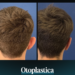 Otoplastica - Estetica e Sorriso