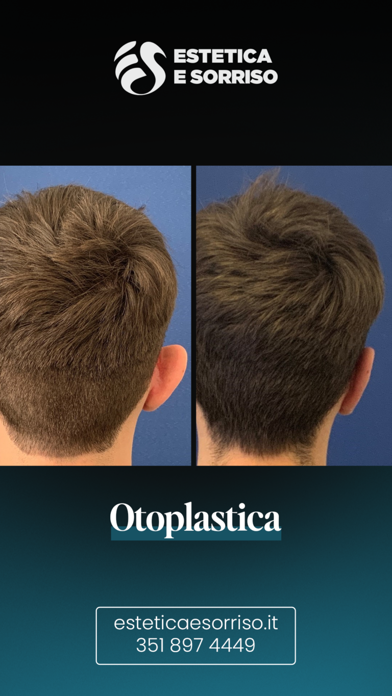 Otoplastica - Estetica e Sorriso