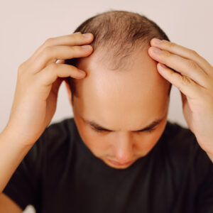 Trapianto di capelli - Estetica e Sorriso