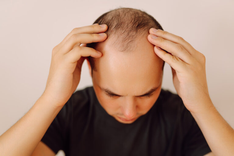Trapianto di capelli - Estetica e Sorriso