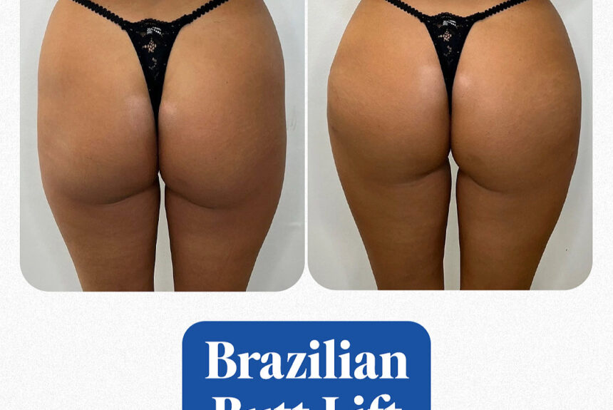 Brazilian Butt Lift - Estetica e Sorriso