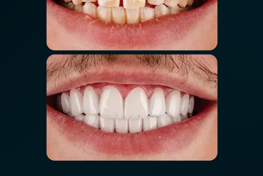 Faccette eMax - Estetica e Sorriso