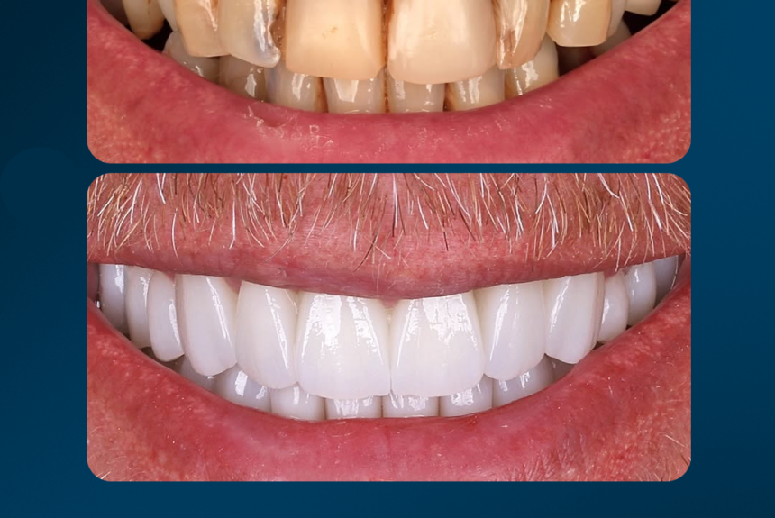 Faccette eMax - Estetica e Sorriso