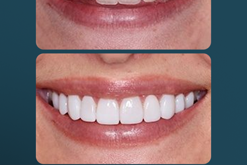 Faccette eMax - Estetica e Sorriso