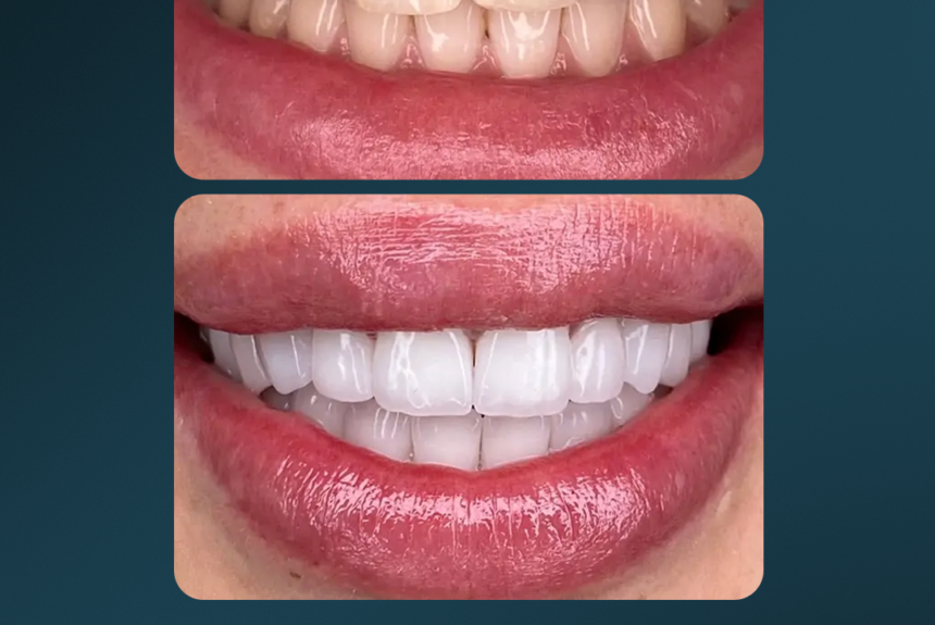 Faccette eMax - Estetica e Sorriso