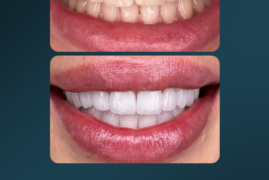 Faccette eMax - Estetica e Sorriso