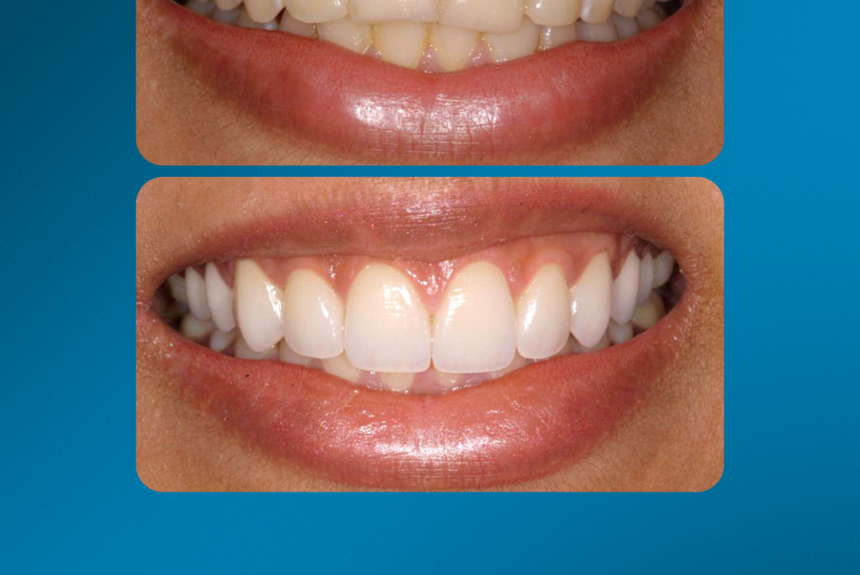 Faccette eMax - Estetica e Sorriso