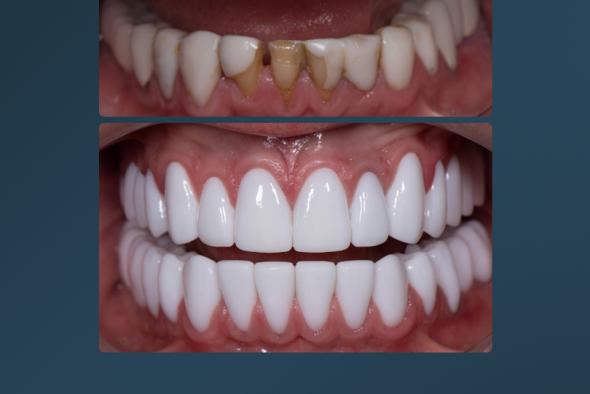 Hollywood Smile - Estetica e Sorriso