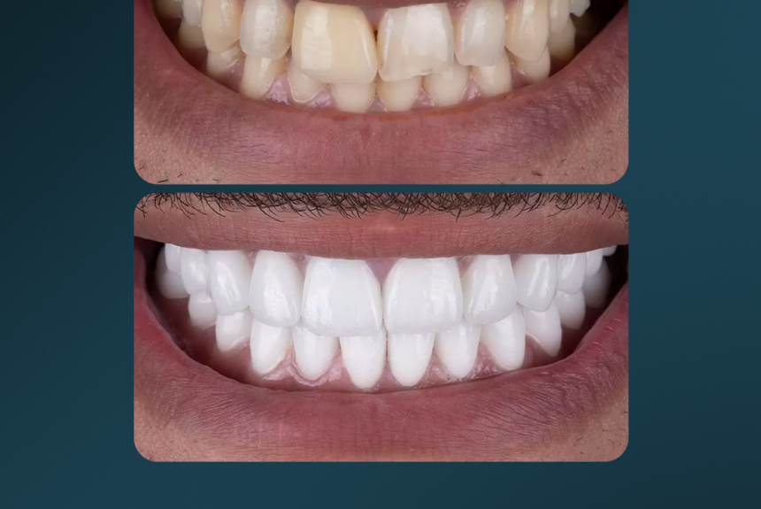 Hollywood Smile - Estetica e Sorriso