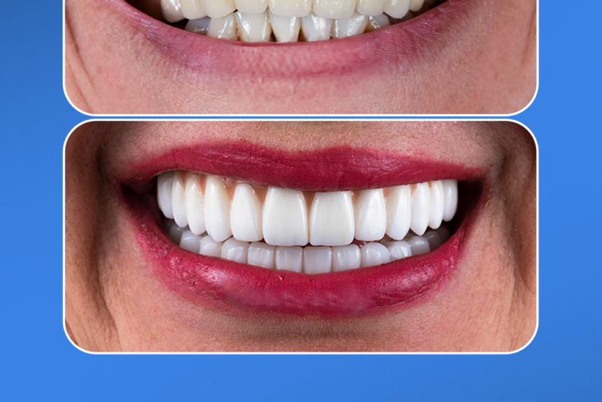 Hollywood Smile - Estetica e Sorriso