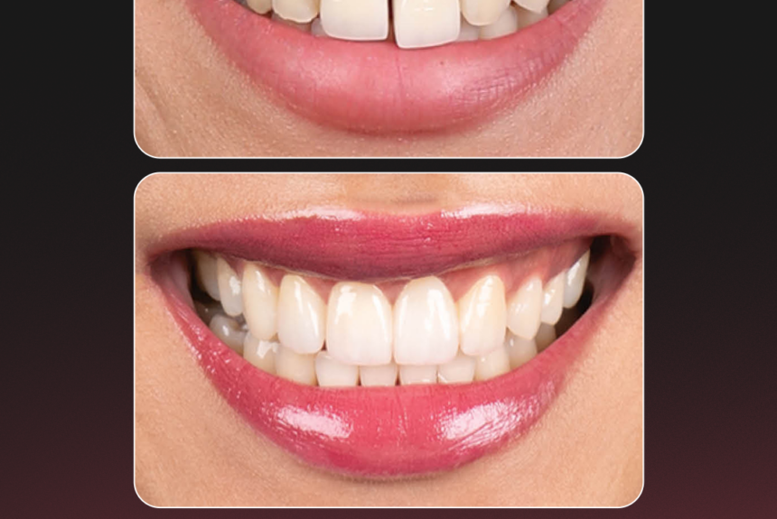 Hollywood Smile - Estetica e Sorriso