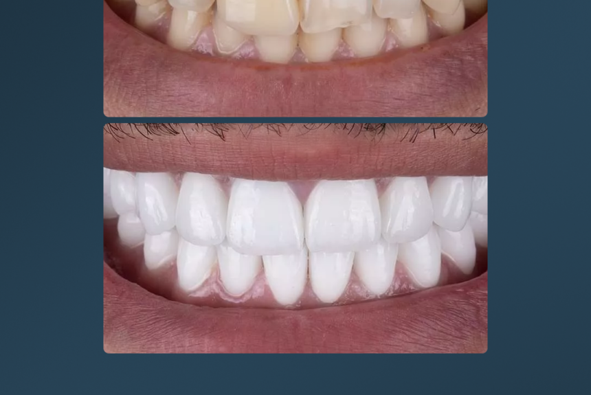 Hollywood Smile - Estetica e Sorriso