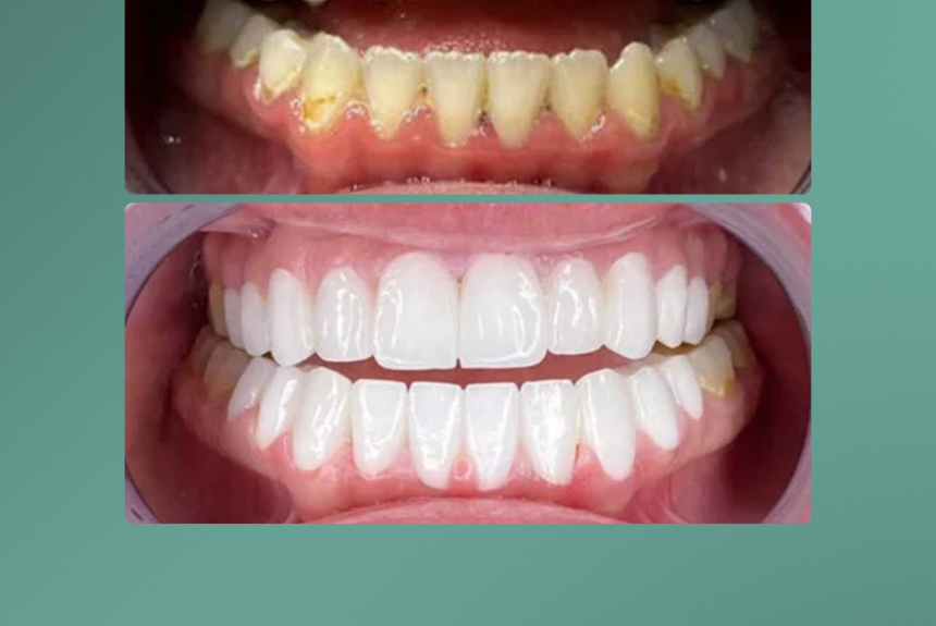 Hollywood Smile - Estetica e Sorriso