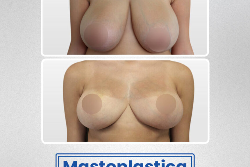 Mastoplastica riddutiva - Estetica e Sorriso
