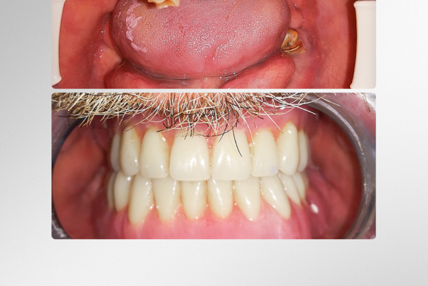 Impianti Dentali - Estetica e Sorriso