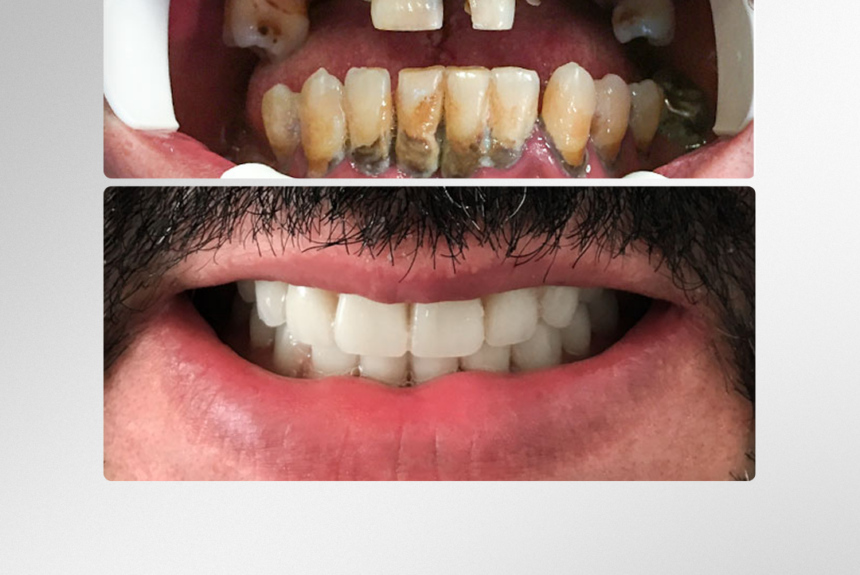Impianti Dentali - Estetica e Sorriso