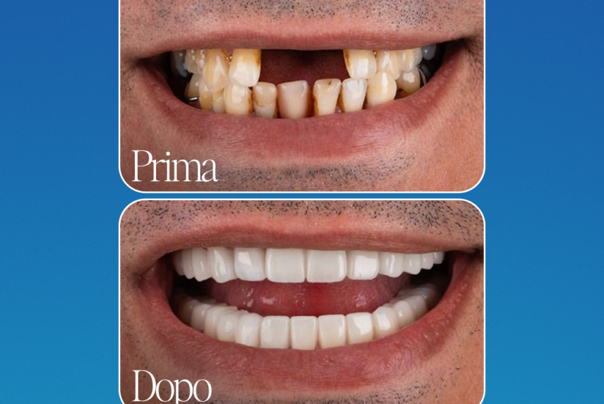 Impianti Dentali - Estetica e Sorriso