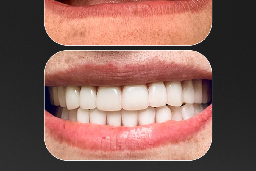 Impianti Dentali - Estetica e Sorriso