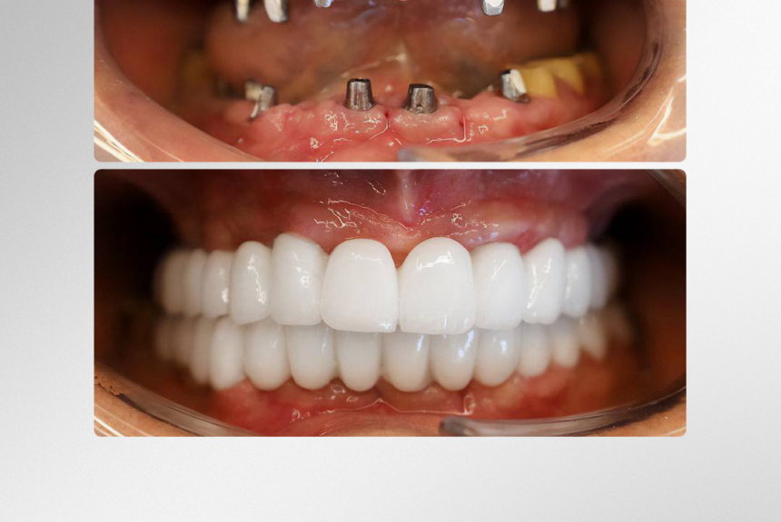 Impianti Dentali - Estetica e Sorriso