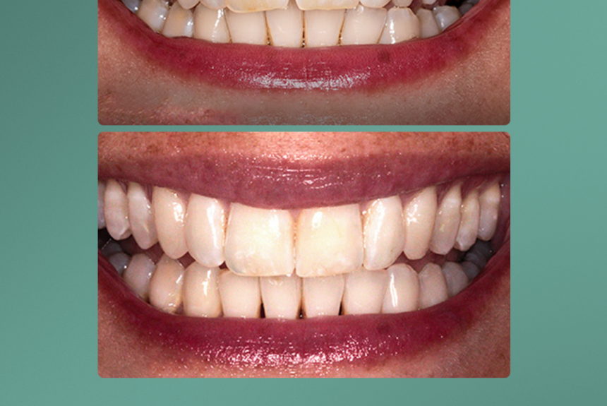 Mascherine Invisibile - Estetica e Sorriso