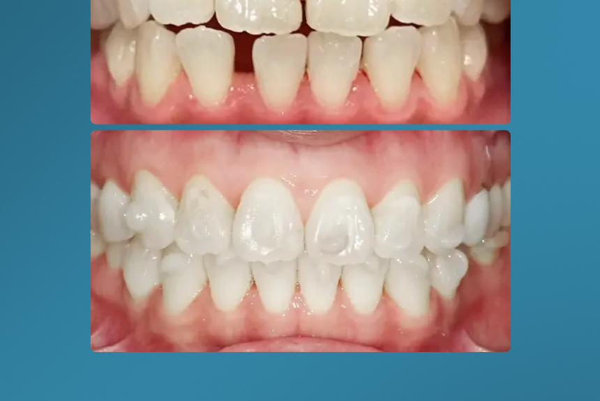 Mascherine Invisibile - Estetica e Sorriso