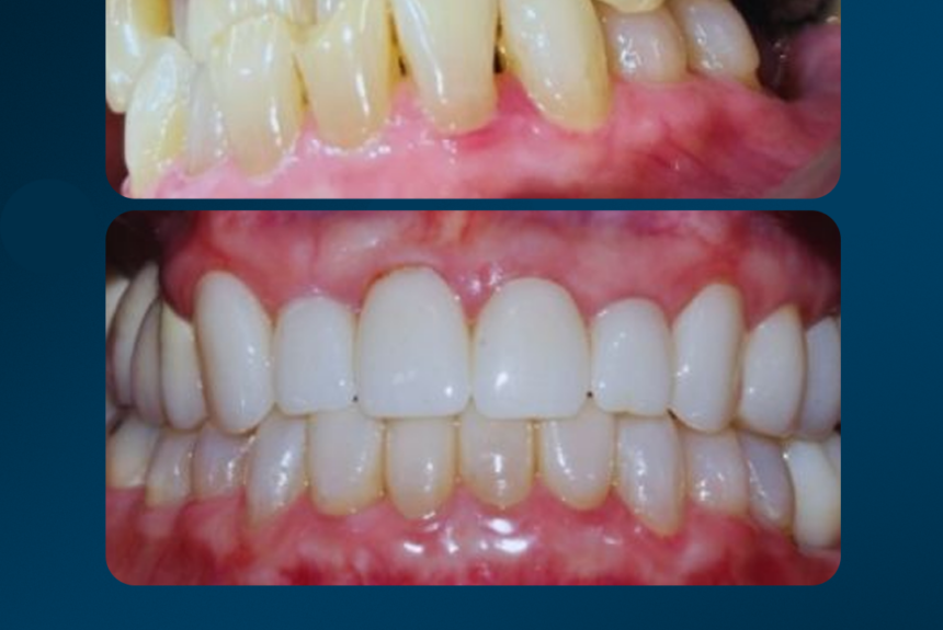 Mascherine Invisibile - Estetica e Sorriso